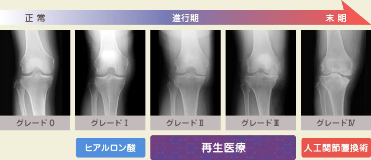 正常 進行期 末期 | グレード0〜5 | グレード1: ヒアルロン酸 / グレード2-3: 再生医療 / グレード4: 人工関節置換術
