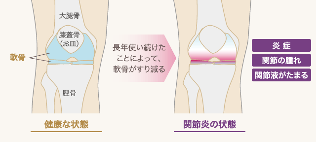 健康な状態 | 長年使い続けたことによって、軟骨がすり減る | 関節炎の状態: 炎症 / 関節の腫れ / 関節液がたまる