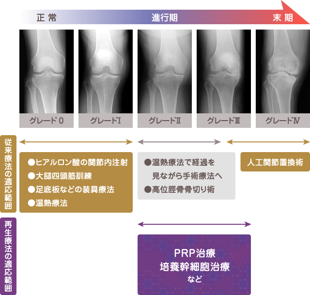 再生医療に期待されるのは、変形性膝関節症の進行抑止