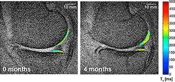培養幹細胞治療後にひざ軟骨で確認された変化