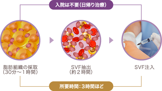 培養幹細胞治療の流れ | 所要時間：３時間ほど | 入院は不要（日帰り治療） | 脂肪組織の採取（30分〜１時間） → SVF抽出（約２時間） → SVF注入