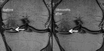 培養幹細胞治療後にひざ軟骨で確認された変化
